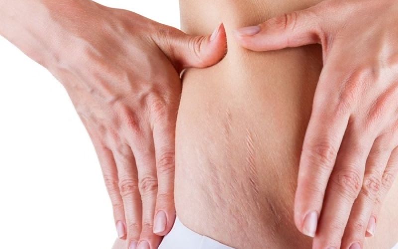 2 Natural ways to deal with stretch marks on our body